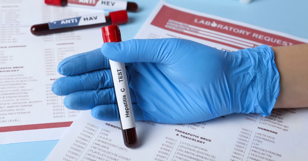 Hepatit C Testi