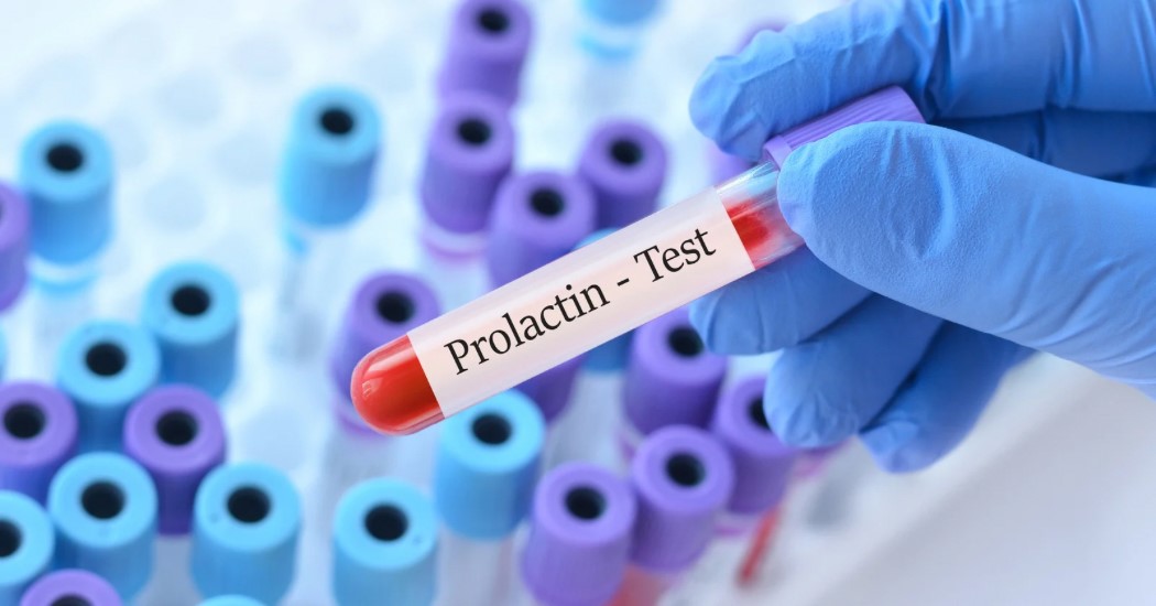 Prolaktin Testi